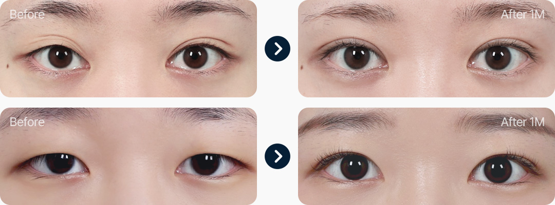 눈매교정 전후사진