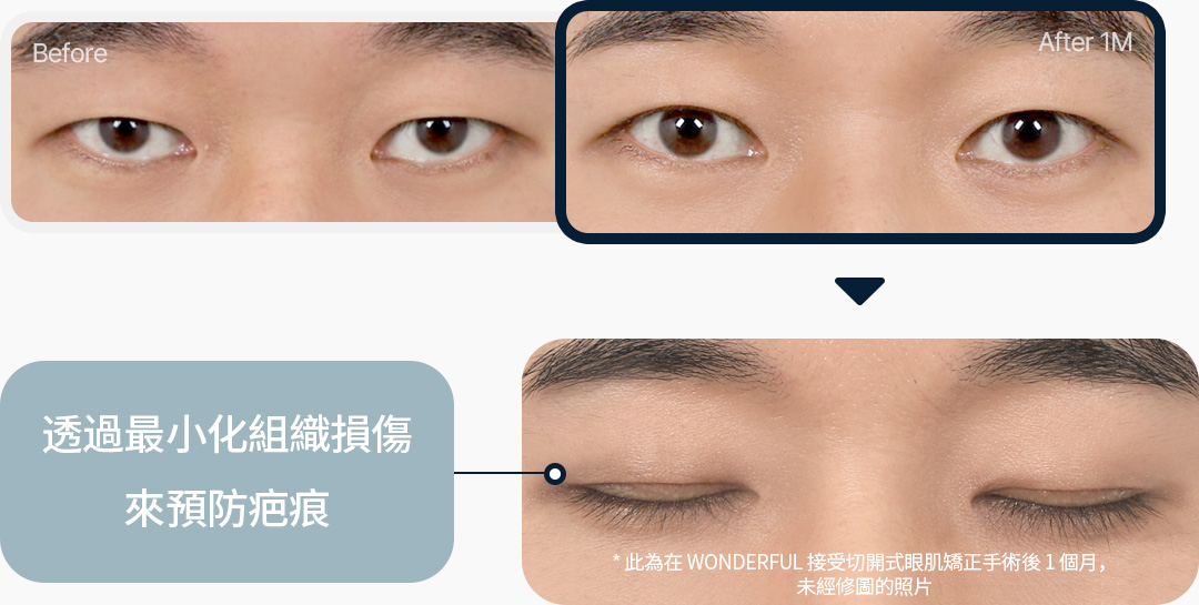 조직손상 최소화 흉터예방