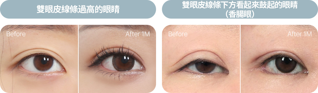 상안검거근 뮬러근