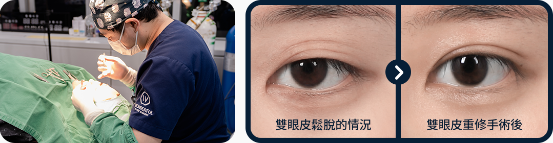 눈재수술 전후사진 원더풀 노하우 강한 고정력