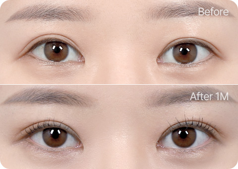 원더풀 완전절개 완전절개+유착풀기+앞트임