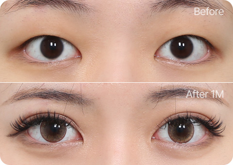 원더풀 자연유착 윗트임 눈위지방제거