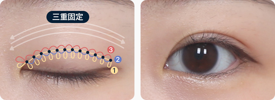 원더풀 자연유착 3중고정