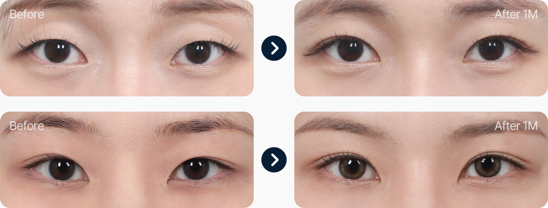 자연유착 전후사진