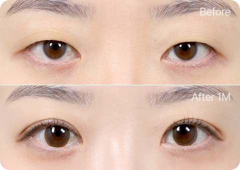 Wonderful 部分切開 앞트임 눈매교정