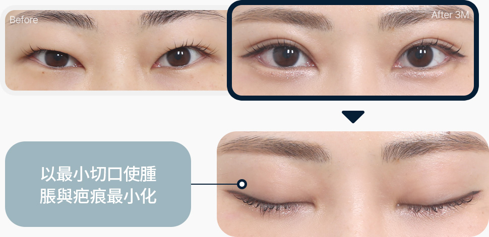 원더풀 라인낮추기 두줄따기 흉터제거 자연스러운 유착