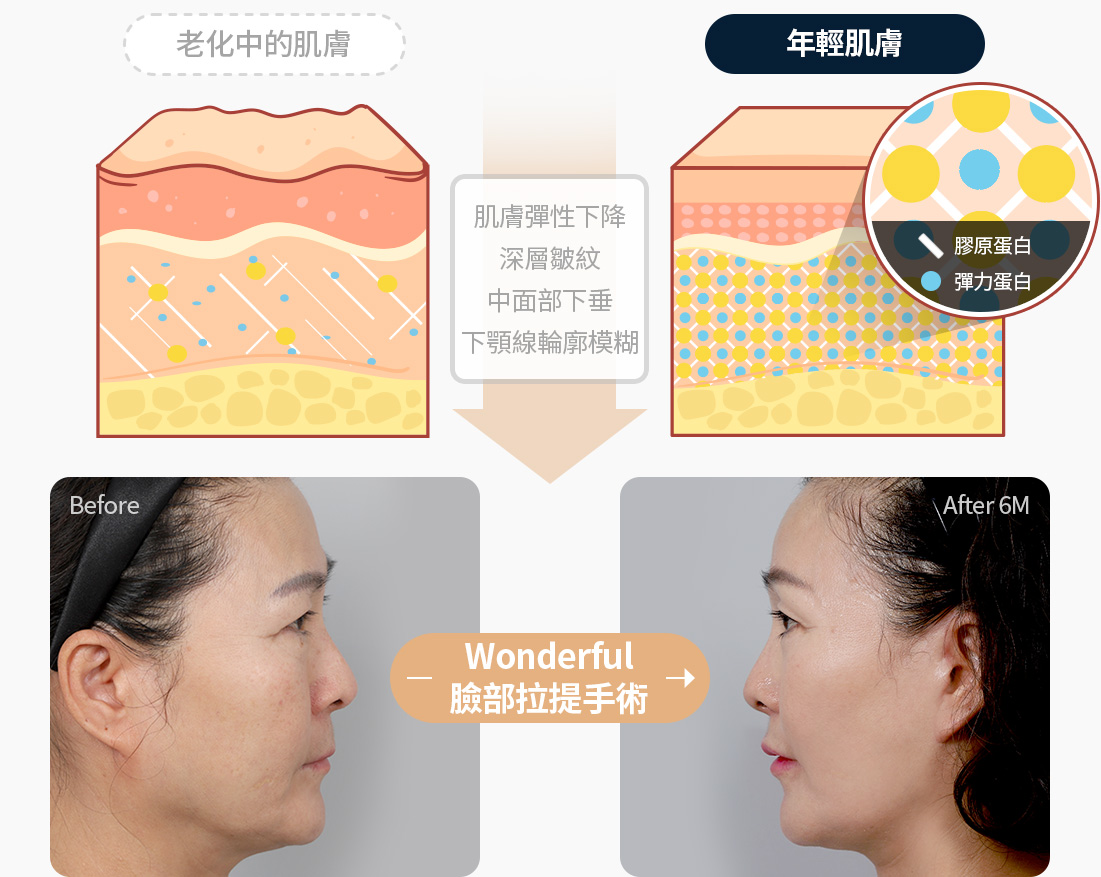 안면거상 노화 진행된 피부 피부탄력저하 깊은주름 중안면부처짐 무너진턱선 원더풀 안면거상 전후사진 안면거상 수술후기