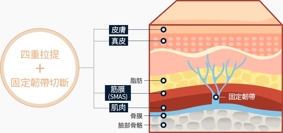 안면거상 4중리프팅 늘어진 유지인대 끊기 피부 진피 근막 근육층 4중으로 당겨 리프팅