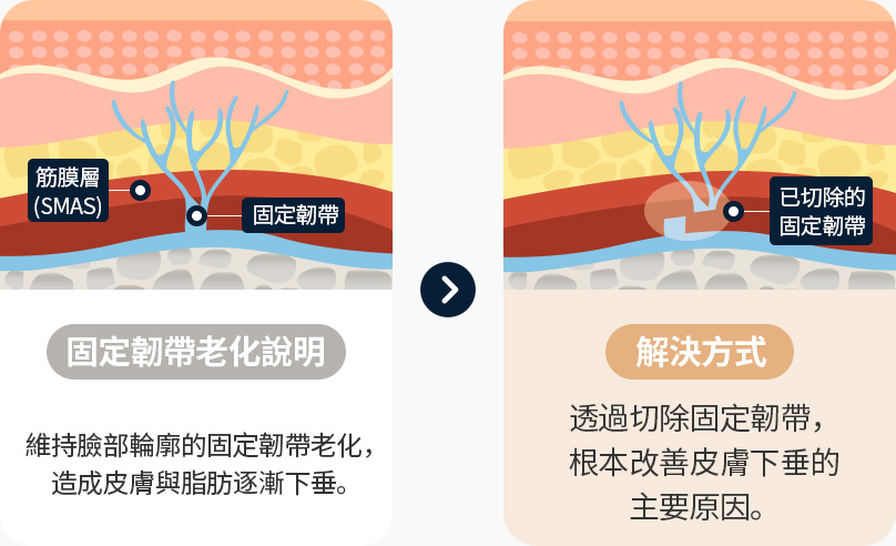 안면거상 근막 유지인대 노화 피부와 지방처짐발생 유지인대를 절제 피부처짐 원인 해결