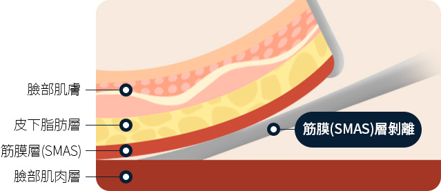 안면거상 안면피부 피하지방층 근막 얼굴근육층 근막층 박리