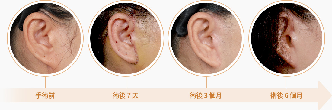 안면거상 섬세한 봉합 흉터 최소화 수술전 7일후 3개월후 6개월후 흉터최소