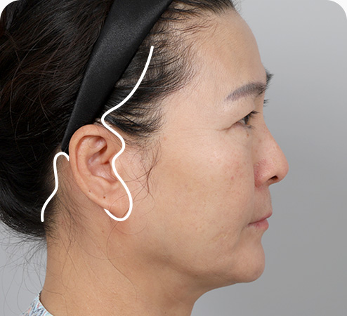 안면거상 수술방법 관자놀이 헤어라인 안쪽에서 귀 경계를 따라 절개