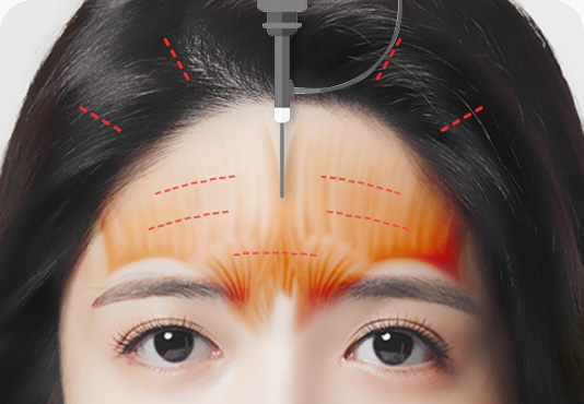 이마거상 수술방법 Full HD 내시경 근육 피부층 박리