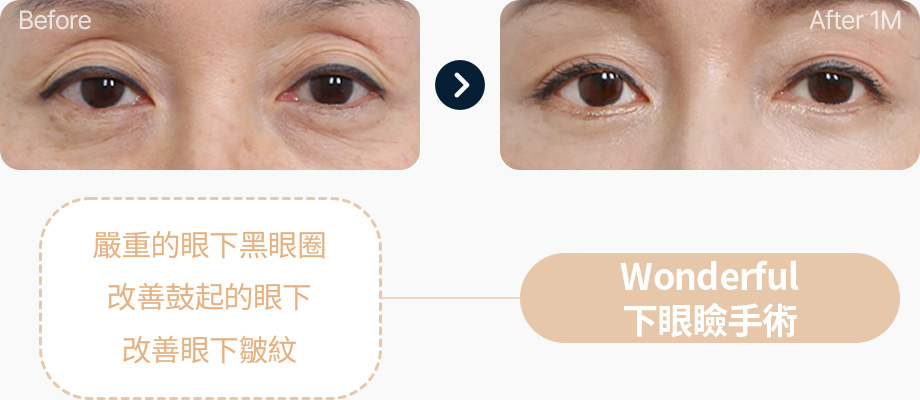 하안검 전후사진 하안검 수술후기 눈밑 다크서클 불룩한 눈밑 눈밑주름 개선 원더풀 하안검
