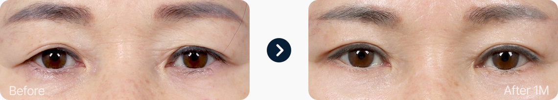 눈썹하거상술 전후사진 눈썹하거상술후기 눈처짐 해결