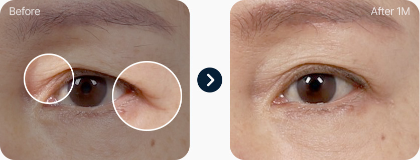 눈썹하거상술 전후사진 눈썹하거상술후기 늘어진 근육 리프팅