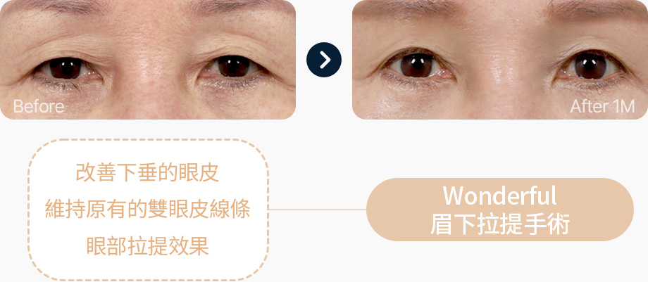 눈썹하거상술 전후사진 눈썹하거상술후기 눈꺼풀처짐 쌍꺼풀라인 유지 눈리프팅 효과