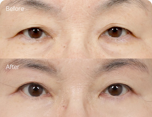 눈썹하거상술 전후사진 눈썹하거상술후기