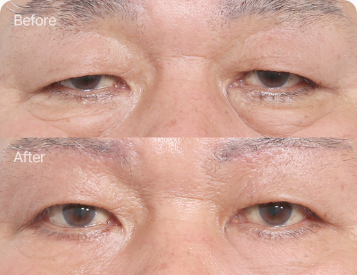 눈썹하거상술 전후사진 눈썹하거상술후기