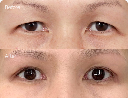 눈썹하거상술 전후사진 눈썹하거상술후기