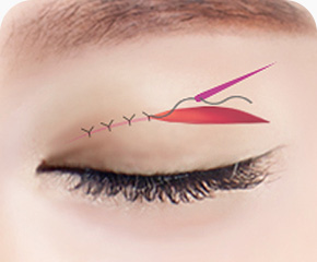 상안검 수술방법 필요 시 눈매교정 병행 눈뜨는 힘 강화 눈꺼풀 피부 봉합