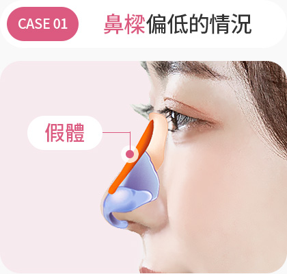 콧대가 낮은경우 보형물 낮은코성형