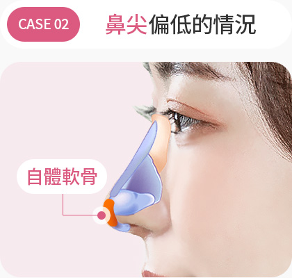 코끝이 낮은경우 자가연골 낮은코성형
