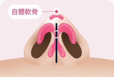 복코 성형 자가연골