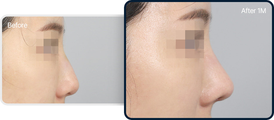 화살코 긴코 성형 전후사진