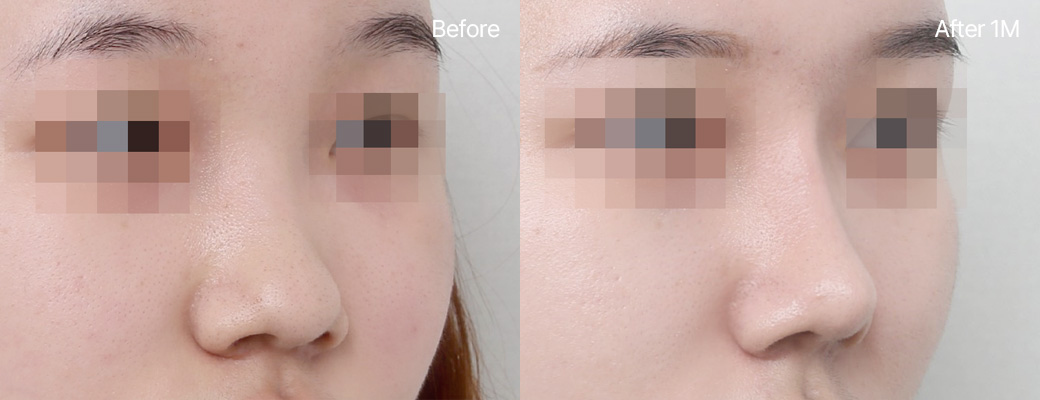 복코성형 자가늑연골+귀연골 전후사진