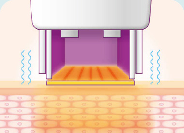 써마지FLX 시술방법 고주파 열에너지 피부 침투 통증 감소 진동