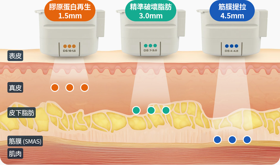 울쎄라 전용팁 1.5mm 콜라겐 재생 3.0mm 지방파괴 4.5mm 근막리프팅