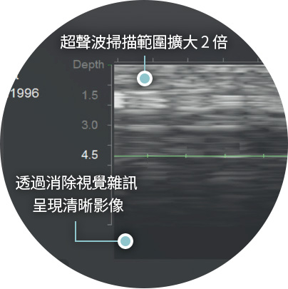 울쎄라 울쎄라피 프라임 울쎄라프라임 실시간 초음파 타켓팅 시술 선명한 이미징
